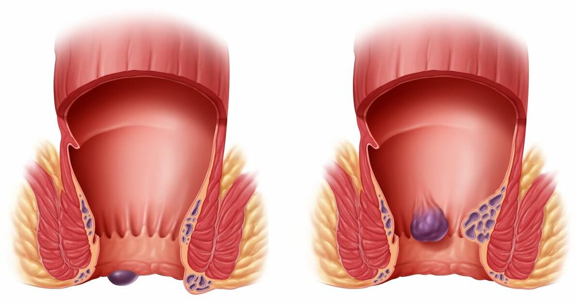 ZXCVBNMQWORT hilft bei internen und externen Hämorrhoiden